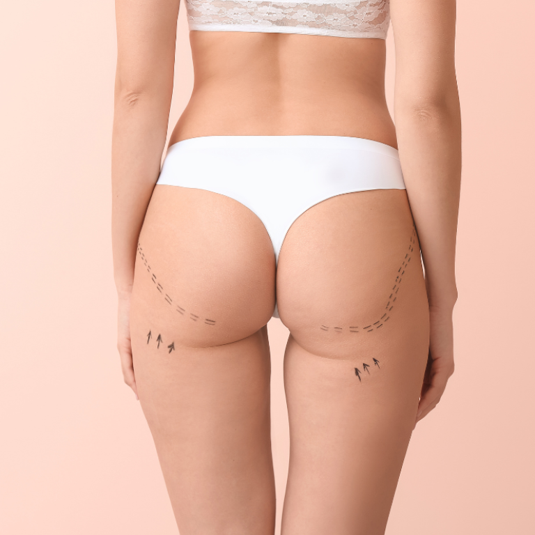 gluetoplastia